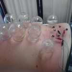 Fire Cupping and E Stimulation Honolulu Hawaii