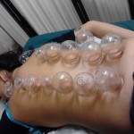 Fire Cupping Honolulu Hawaii