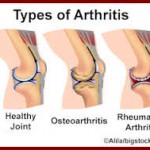 arthritis