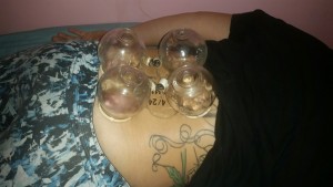 Fire_Cupping_Honolulu_Hawaii_Oahu_1