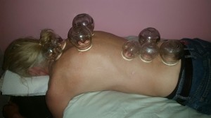 Fire_Cupping_Honolulu_Hawaii_Oahu_5