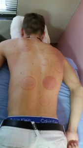 Fire_Cupping_Honolulu_Hawaii_Oahu_6