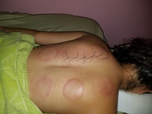 Fire_Cupping_Honolulu_Hawaii_Oahu_8