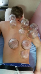 Fire_Cupping_Honolulu_Hawaii_Oahu_9