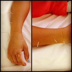 AcupunctureTxKimWoozy - Acupuncture Arts Hawaii Two-panel view of a person lying with acupuncture needles inserted along the forearm and hand.