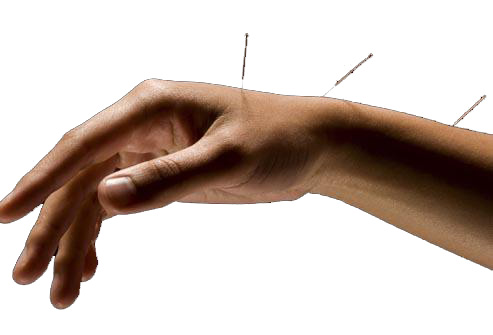 Carpal-Tunnel-Acupuncture - Acupuncture Arts Hawaii Carpal-Tunnel-Acupuncture
