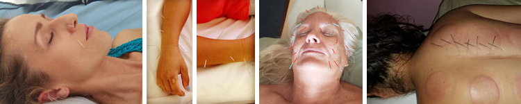 Acupuncture and Traditional Chinese Medicine - Chinese Medicine Hawaii - Honolulu - Oahu