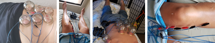 Electrostimulation Traditional Chinese Medicine - Chinese Medicine Hawaii - Honolulu - Oahu