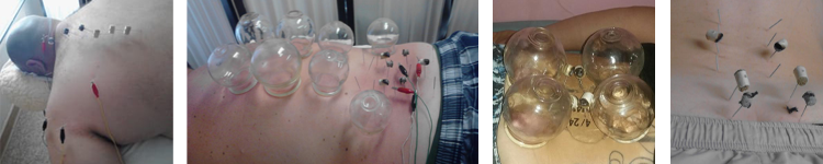 Moxibustion Traditional Chinese Medicine - Chinese Medicine Hawaii - Honolulu - Oahu